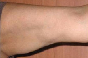 Paciente con flacidez corporal brazo