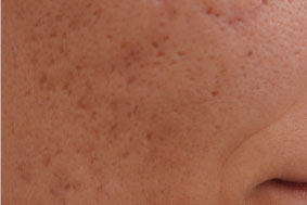 Cicatrices de acné tipo puntiforme