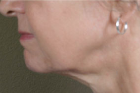 Tratamiento radiofrecuencia endymed cuello