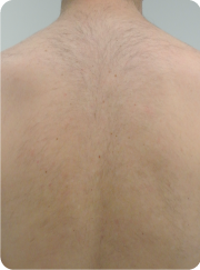 Resultado depilación láser diodo vectus espalda hombre