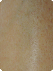 Resultado depilación láser diodo vectus piernas mujer hombre